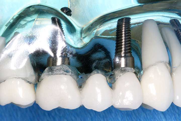Implantes y cirugía oral