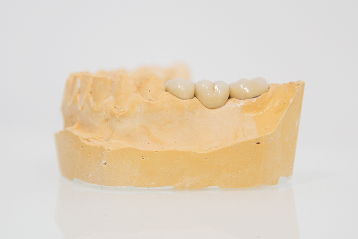 Prótesis dentales
